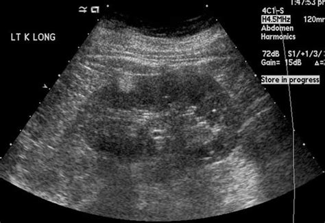 Junctional parenchymal defect of kidney | Radiology Reference Article | Radiopaedia.org ...