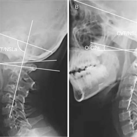 An 8-year-old girl undergoing atlantoaxial fusion due to transverse ...