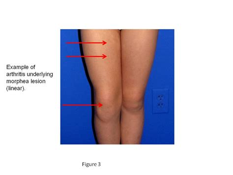 Morphea (Localized Scleroderma) - Cancer Therapy Advisor