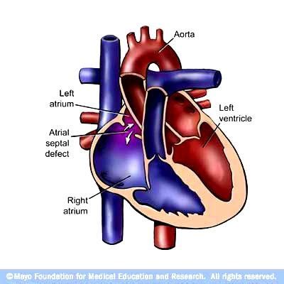 ASD. Blood from the pulmonary veins enters the left atrium, after which... | Download Scientific ...