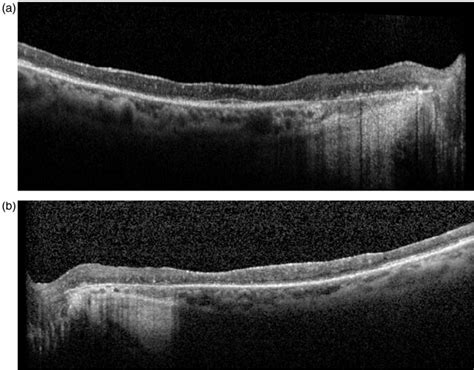 (a) Macular OCT OD. Loss of architecture of the inner retinal layers ...