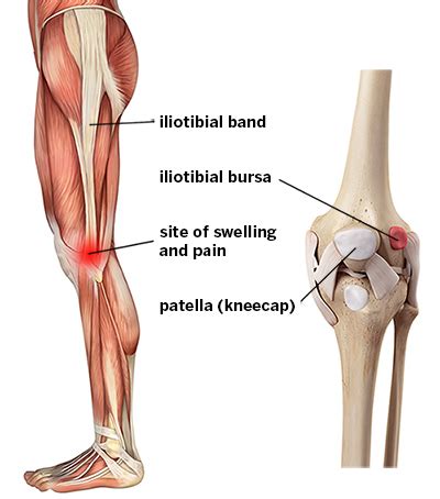 IT Band Syndrome: Knee Pain Symptoms & Treatments | HSS