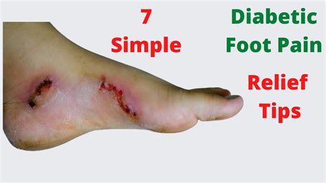 Foot Pain In Diabetes Cure at George Mullikin blog