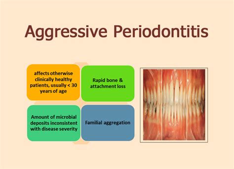 Aggressive Periodontitis - Focus Dentistry