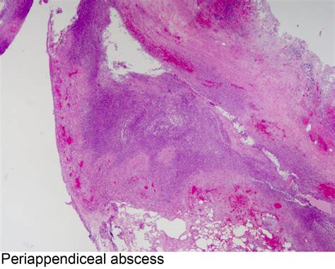 Pathology Outlines - Acute appendicitis