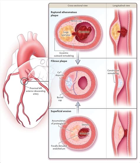 Mechanisms of Acute Coronary Syndromes and Their Implications for ...