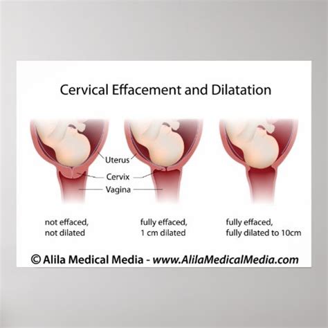 Cervical effacement and dilatation chart poster | Zazzle