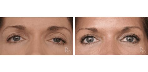 Blepharoplastiek En Ptosiscorrectie