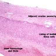 Microscopic examination of cyst wall showing luteinized theca cells (H... | Download Scientific ...