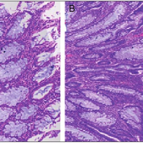 Semi-pedunculated colon polyp (Paris 0-1sp; Kudo's pit type III L ) (a ...