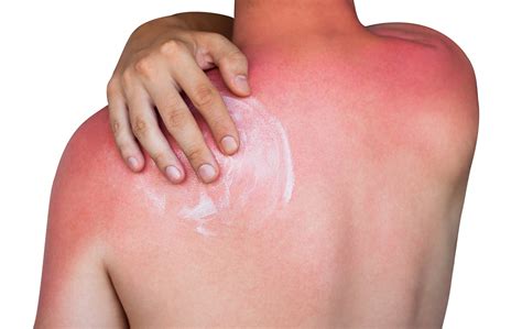 6 Ways You're Making Your Sunburn Worse