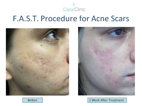 Ask the Expert: What is the Best Treatment for Ice Pick Acne Scars