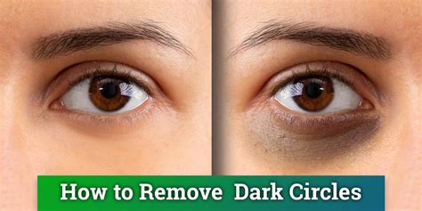 Dark Circles Under Your Eyes—Causes and Treatment - Western Pennsylvania Healthcare News