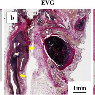 Histopathological findings. (a, b, c) A 1.5 mm diameter bronchial ...