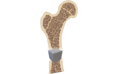 Bone-building cells favour different orthopaedic implant designs, study finds | Loughborough ...