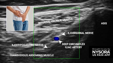 Case study: Ilioinguinal neuralgia - Injection - NYSORA