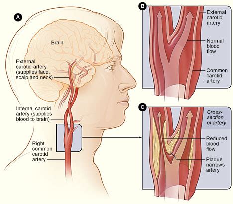 Carotid Endarterectomy and Stent | Brain Institute | OHSU