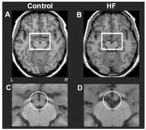 Abstract 2717: Brain Mammillary Body Volumes are Diminished in Heart ...