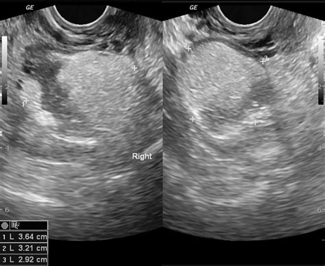 Dermoid cyst ultrasound - wikidoc