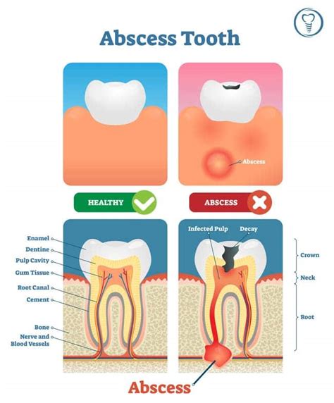 Dental Abscess - Stages, Causes, Symptoms & Treatments | Blog