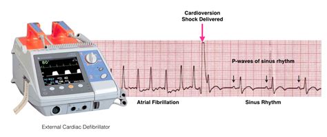 Electrical Cardioversion - One Heart Cardiology