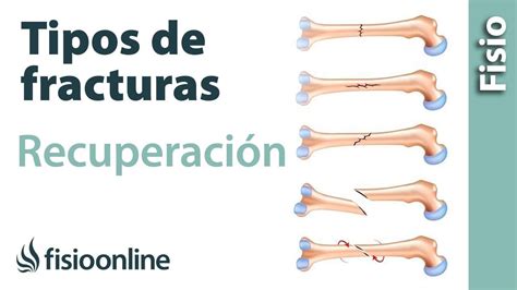 Fracturas de hueso. Cuáles son sus diferentes tipos y su recuperación | FisioOnline