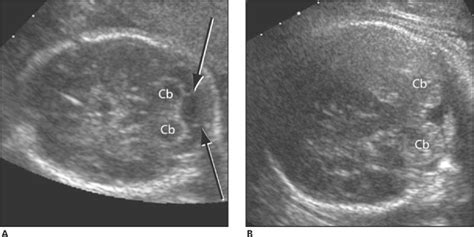 Cisterna Magna Ultrasound