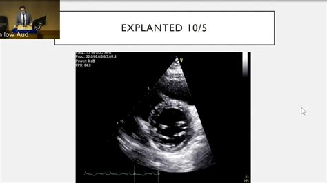 Myocardial Recovery in Cardiogenic Shock on Mechanical Support – Cellular Mechanisms - BroadcastMed