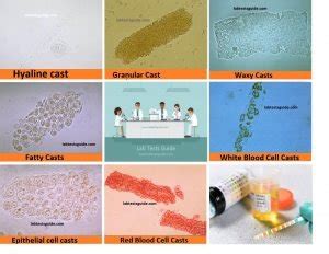 Urinery Casts Types, Results And Clinical Significations | Lab Tests Guide