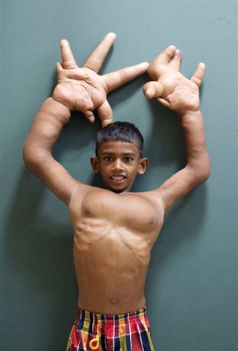 'Boy with the World's Biggest Hands' measuring 33cm has surgery to reduce their size - Mirror Online