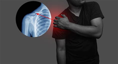 About Collarbone (Clavicle) Fractures | Dr. Kyle McClintock - Roseville, CA