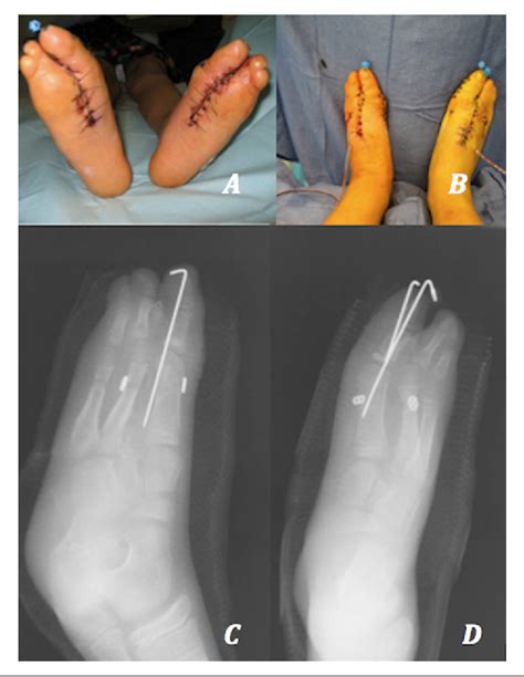 Treatment of Cleft Foot Deformity With a Suture-Button Construct in the ...