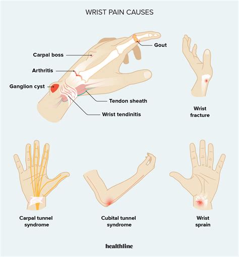 Prehistoric Opposition Prisoner wrist and ankle pain no swelling enthusiasm Roar blessing