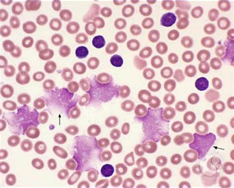 Chronic Lymphocytic Leukemia: Thrombocytopenia - 2.