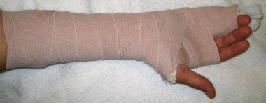 Ulnar Gutter Splinting: Background, Indications, Contraindications