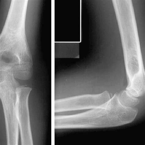 Case 9 e pelvis: OA right hip confused with subcapital fracture ...