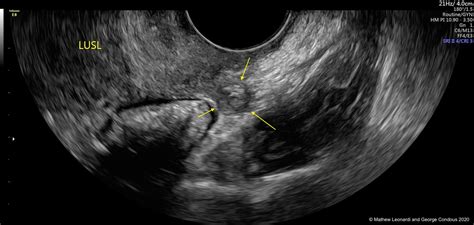 Noninvasive ultrasound diagnosis of endometriosis | Contemporary OB/GYN