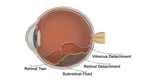 Flashes & Floaters - ERIE RETINAL SURGERY