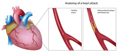 Acute Coronary Syndrome Video - PELAJARAN