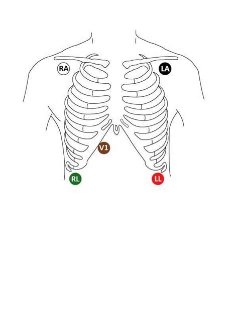 Heart monitor lead placement - bingulsd