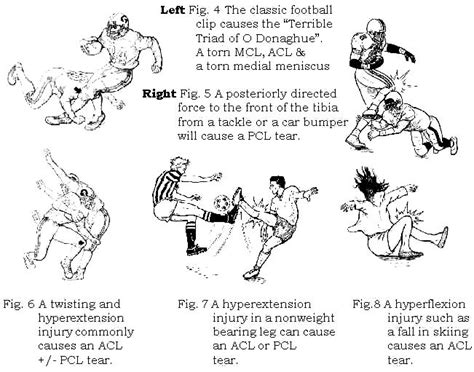 welterxoif - torn acl exercises