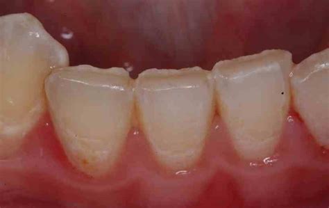 Is Tooth Wear Normal? - Lee Ann Brady, DMD's Dental Blog