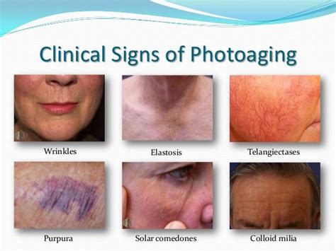 photoaging - Google Search