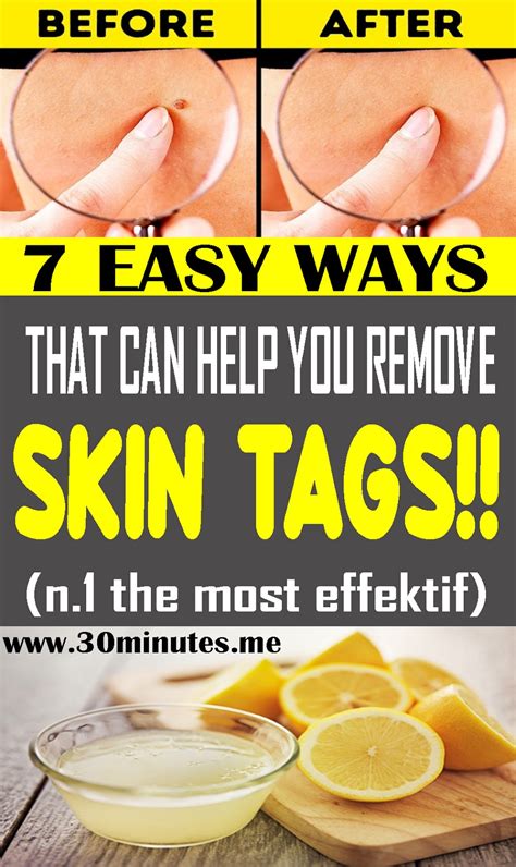 Here Are 7 Easy Ways That Can Help You Remove Skin Tags!!! - HEALTH and ...