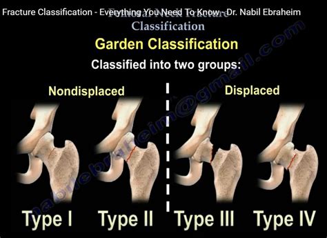 Garden Classification Femoral Neck Fracture