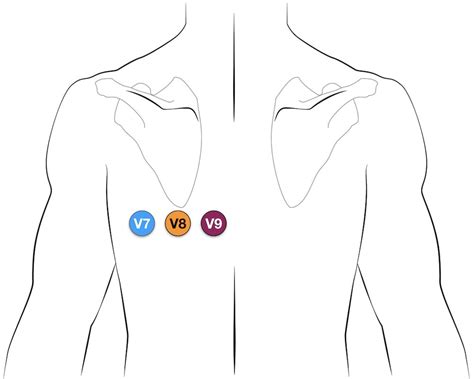 Holter Monitor 5 Lead Placement Diagram - Wiring Diagram