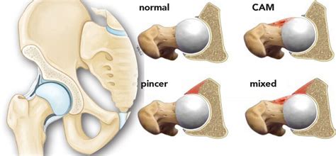 Femoroacetabular Impingement (FAI) - CNOS