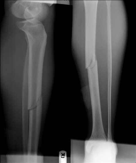 orthopedics - How to tell if my leg fracture is healing? - Health Stack Exchange