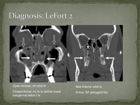 Lefort 2 Fracture