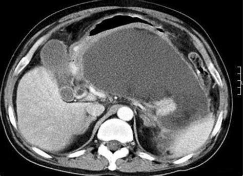 CT scan showing large pancreatic pseudocyst in the lesser sac. CT ...